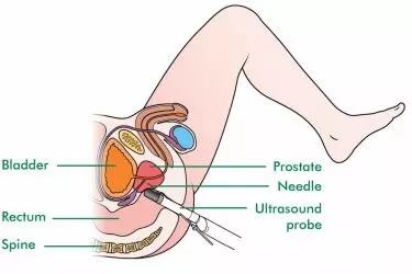 trus ultrasound in gurgaon