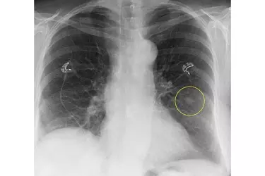 uses of xray test in diagnosing diseases